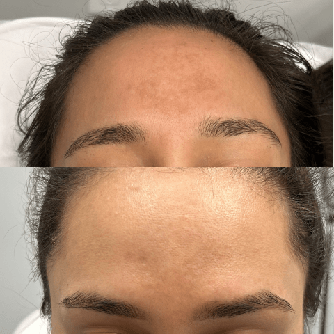 Melasma Treatment